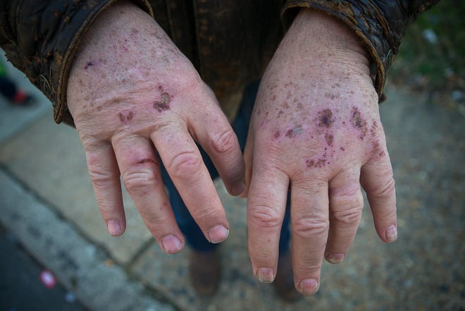 Jim Shanahan shows the scars on both his hands caused by the pit bull attack that occured on Sunday.